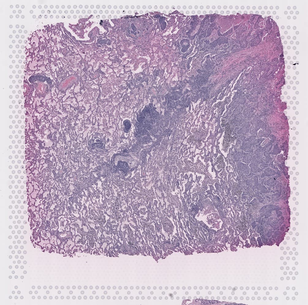 H&E-stained lung tissue, with predicted spatial gene expression over its right half