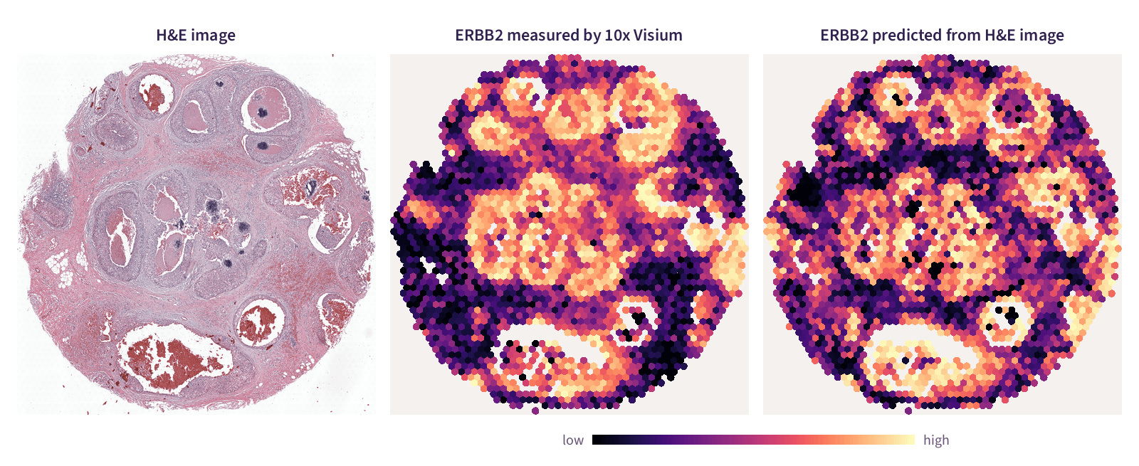 Three views of the same breast cancer section. On the left is the H&E stained tissue, in the middle ERBB2 (HER2) as measured by 10x Visium, and on the right ERBB2 predicted from the H&E image alone, where both maps show the highest levels in the tumour nests and lower levels in the surrounding tissue.